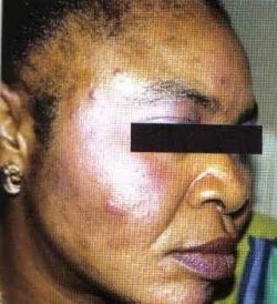 depigmentation
