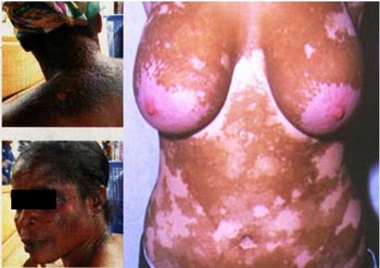 depigmentation