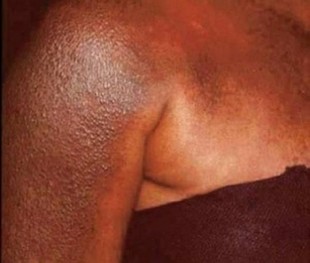 depigmentation