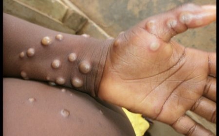 Mpox : un cas découvert au Mali