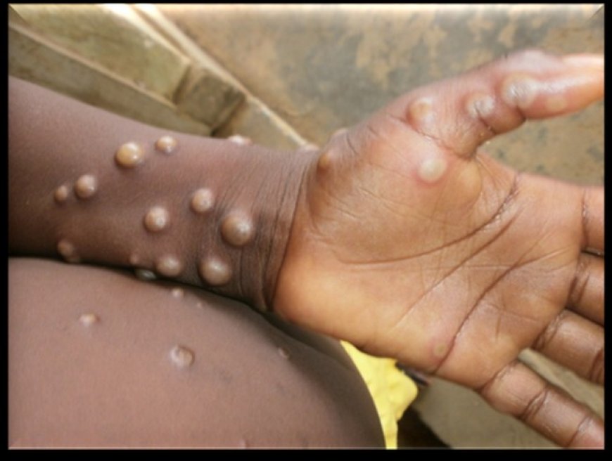 MPOX	 : Un premier cas confirmé et mortel dans la région de Koulikoro