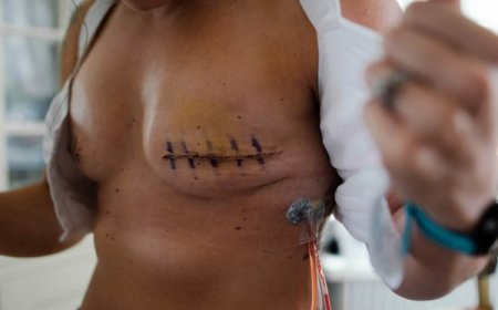 Cancer du Sein et Stigmatisations au Mali : La Mastectomie, un Mal qui Tue plus que le Cancer ?
