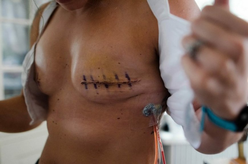 Cancer du Sein et Stigmatisations au Mali : La Mastectomie, un Mal qui Tue plus que le Cancer ?