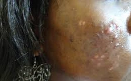 Dépigmentation :  Péril sur la beauté féminine