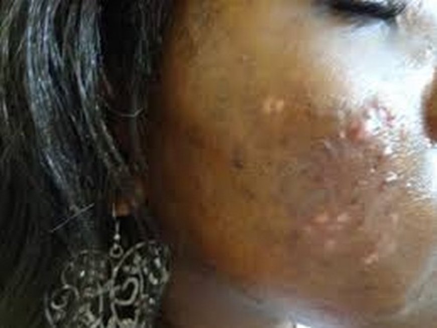 Dépigmentation :  Péril sur la beauté féminine
