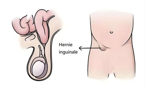 Hernie inguinale : Une maladie courante  chez les Maliens