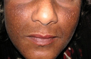 Dépigmentation : Un complexe d’infériorité ou un simple plaisir ?