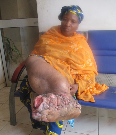 Atteint d’éléphantiasis :  Mariam Maguiraga à la recherche d’une prise en charge