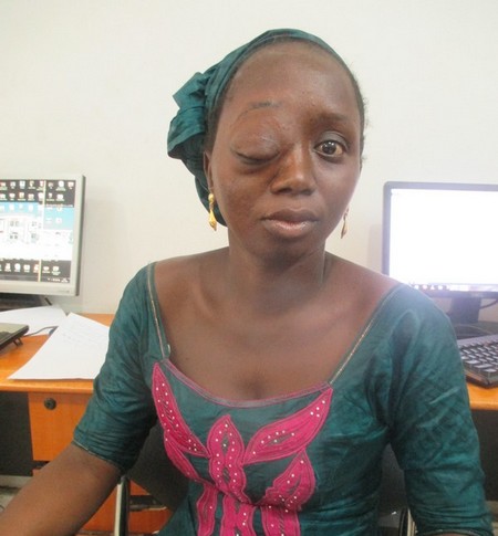 Atteinte d’une tumeur bénigne :  Oumou Sissoko en quête de solidarité pour des soins à l’Etranger