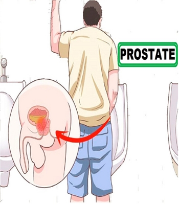 Sante : Causes et conséquences de la prostate