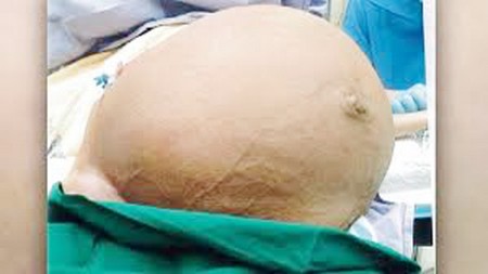 Santé publique : 4,55% de femmes maliennes sont atteintes de fibrome utérin