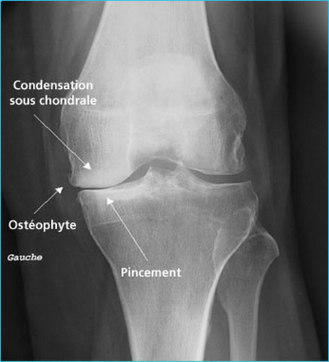 Arthrose :  Une maladie à traiter de longue à haleine !